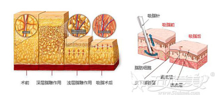 吸脂手术原理