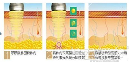 激光溶脂原理