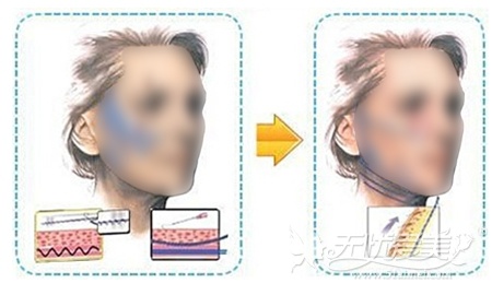 面部线雕提升手术原理