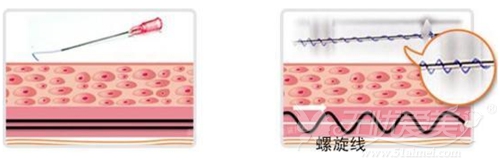 面部线雕提升手术使用的PPDO线