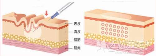 韩国自体真皮再生术注射原理