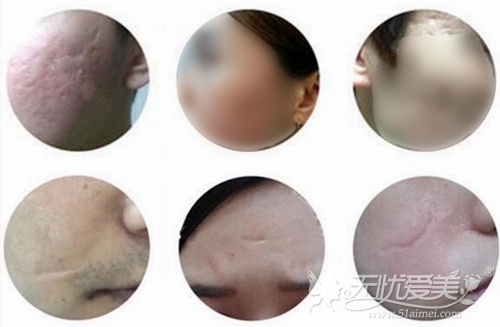 韩国自体真皮再生术适应的症状