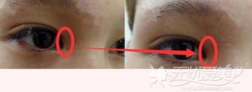韩国自体真皮再生术去除眼角手术后凹陷案例