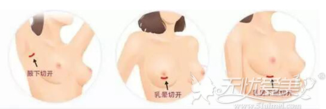 假体隆胸的手术切口位置