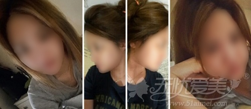 美女在韩国ID整形医院做面部脂肪移植+鼻整形全过程
