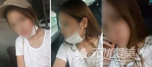 敏珠在韩国ID整形医院做完面部脂肪移植+鼻整形术后一周