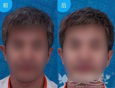 男士做超声刀前后对比案例