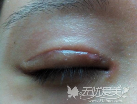 双眼皮术后正常疤痕增生期