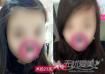 【案例】找长沙雅美田芳斌专家做双眼皮手术恢复全过程