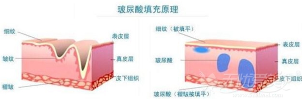 眼角有皱纹 应该选择玻尿酸还瘦脸针？