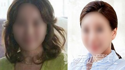 44岁大妈在韩国原辰做面部提升+自体脂肪填充全过程