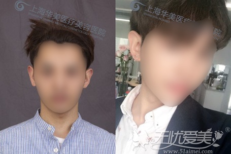 在上海华美做了双眼皮手术前后对比 在上海华美做了双眼皮手术前后对比