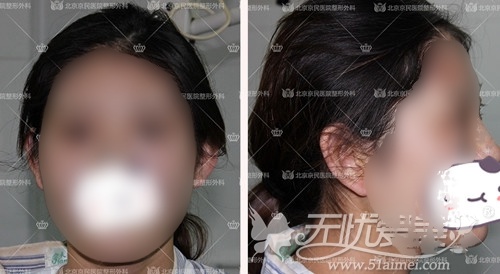 刘小姐在北京京民做双眼皮手术当天