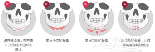 是韩国X切骨V—line手术过程