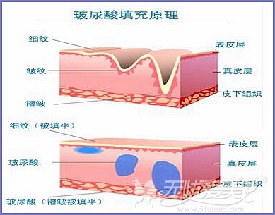 玻尿酸填充原理