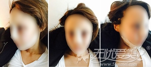模特在韩国灰姑娘整形医院做面部轮廓+眼鼻整形术后2天