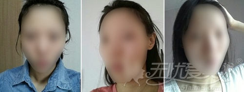 模特在韩国灰姑娘整形医院做面部轮廓+眼鼻整形术前