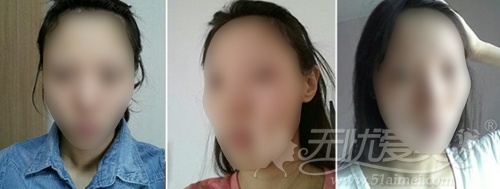 美女模特在韩国灰姑娘做面部轮廓+眼鼻整形半年恢复过程
