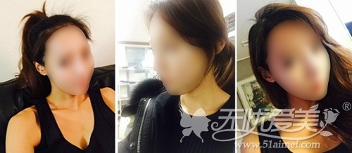 模特在韩国灰姑娘整形医院做面部轮廓+眼鼻整形术后1个月
