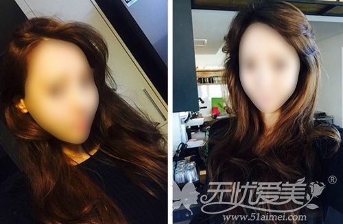 模特在韩国灰姑娘整形医院做面部轮廓+眼鼻整形术后2个月