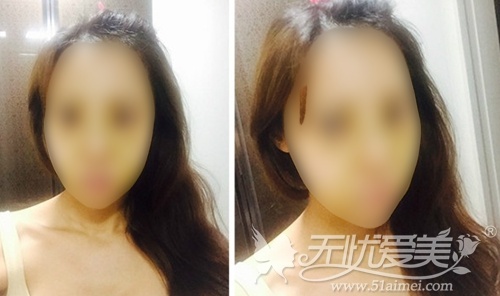 模特在韩国灰姑娘整形医院做面部轮廓+眼鼻整形术后7天