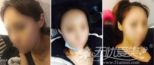 模特在韩国灰姑娘整形医院做面部轮廓+眼鼻整形术后2周