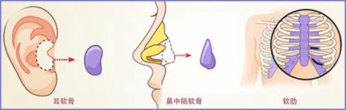 耳软骨鼻中隔软骨肋骨