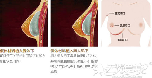 假体隆胸手术切口