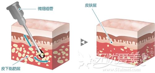 韩国纳米面部吸脂术 减脂+提升一次搞定