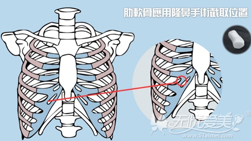 韩国自体肋骨隆鼻选取软骨的部分