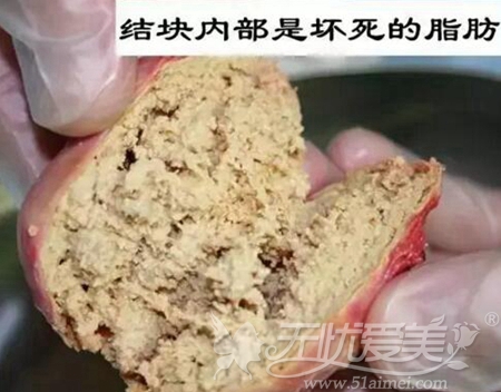 45岁脂肪隆胸坏死图片