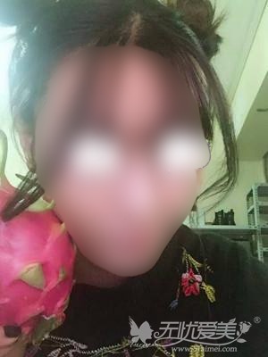 在上海天大做自体脂肪填充手术后半年 在上海天大做自体脂肪填充手术后半年