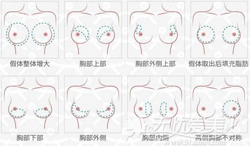 韩国PRP自体脂肪隆胸可以改善的胸部问题