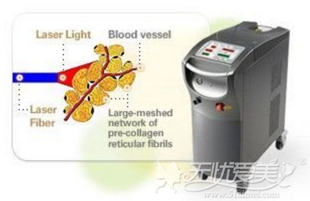 ACCU激光溶脂仪器