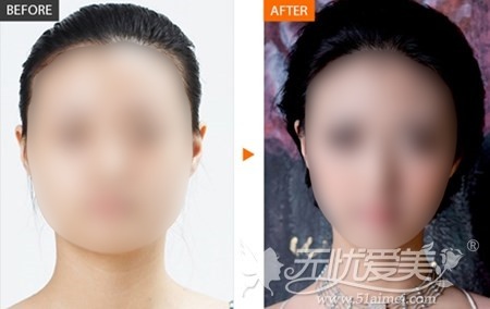 韩国“Elasculpt面部轮廓”手术案例