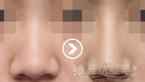 韩国”黄金3D芭比线条鼻综合“手术案例