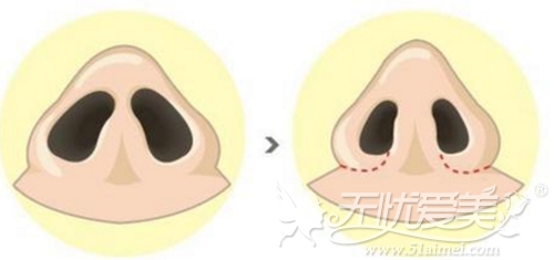 韩国鼻综合——鼻背成型与鼻骨缩窄