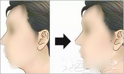假体隆下巴后多久才能消肿？