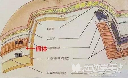 假体隆下巴后移位