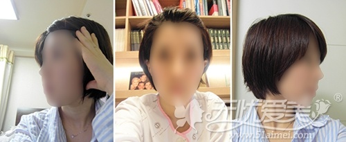 我在韩国灰姑娘整形医院做自体脂肪填充+鼻综合的经历