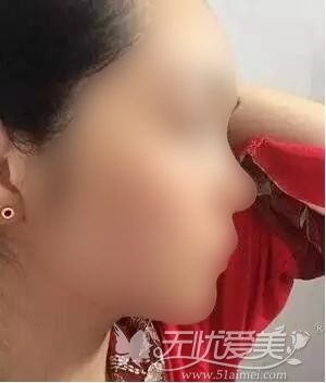 在漳州美博士做鼻综合整形的亲身经历 让我做回精致女人