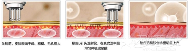 注射水光针的原理