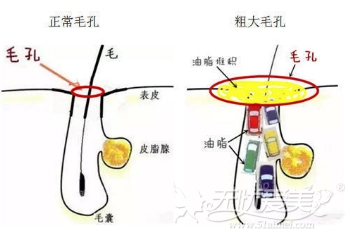 正常毛孔和粗大的毛孔对比图