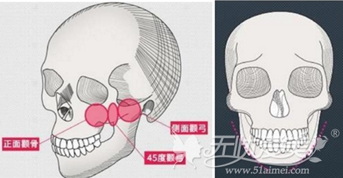 韩国轮廓三件套手术方法