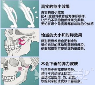 韩国颧骨缩小手术的过程