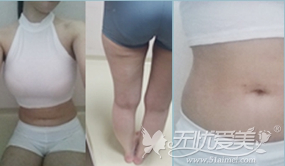 在韩国原辰做全身吸脂术后2周照片