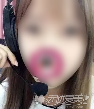 术后40天效果