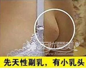 如何判断自己有副乳