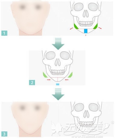 韩国TV-line颜面轮廓手术v线条—下颌角+前下巴整形