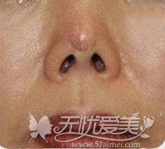 假体隆鼻后鼻头出现凹陷